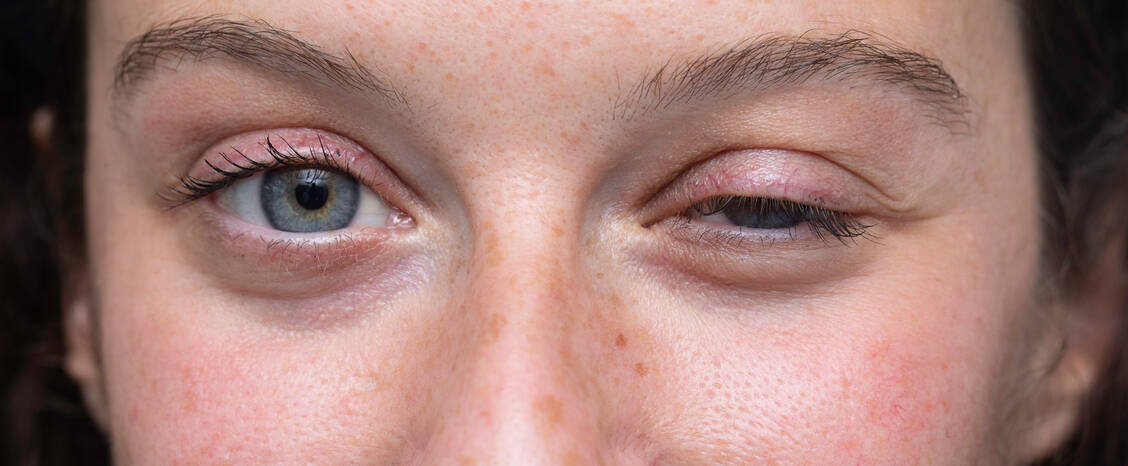 Neu-auf-dem-Markt-Nipocalimab-bei-Myasthenia-gravis