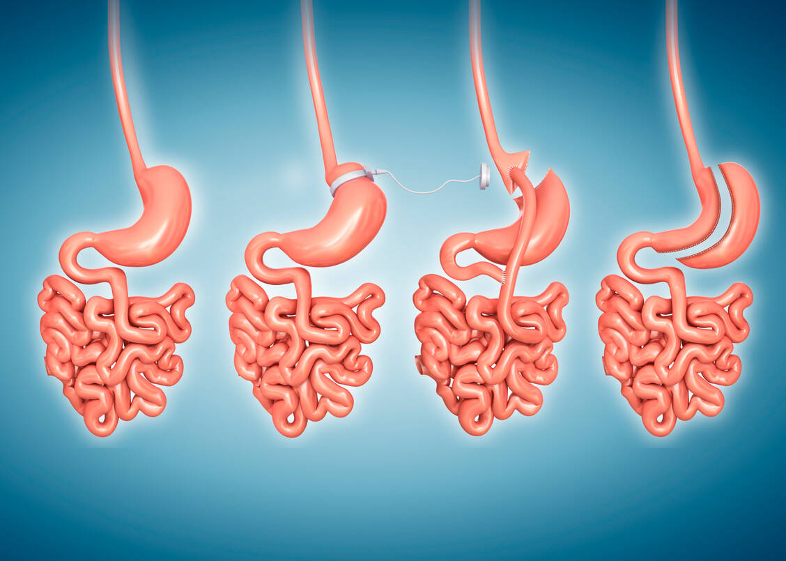 Adipositas-Chirurgie-F-r-wen-und-wie-