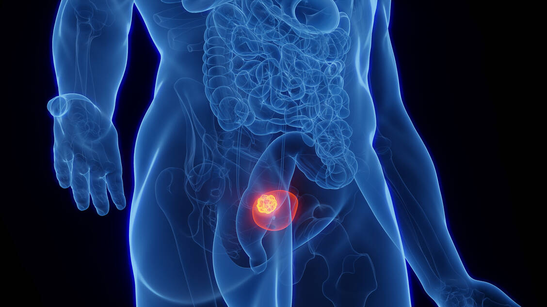 Zulassungsempfehlung-Neue-Option-bei-Blasenkrebs-in-Sicht