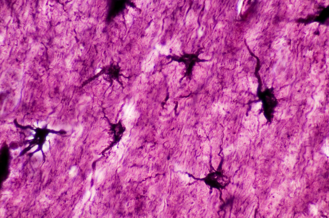 Vorasidenib-Neuer-Kinasehemmer-f-r-Patienten-mit-Gliom