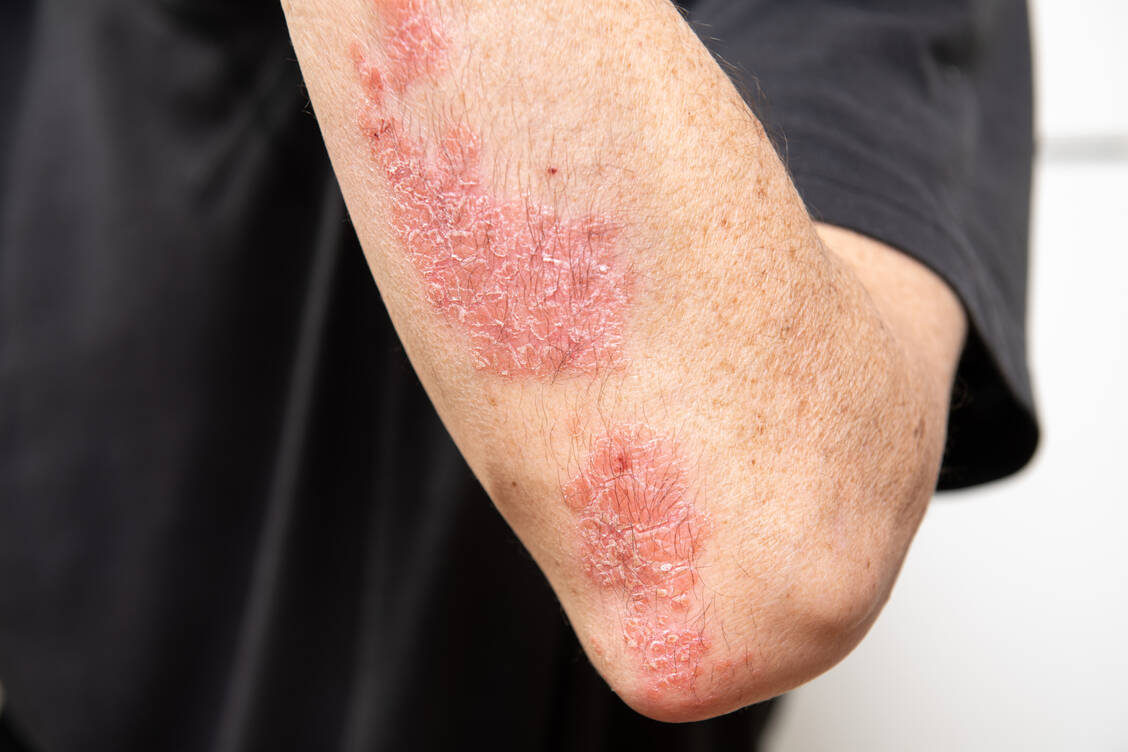 Icotrokinra-Neue-orale-Therapieoption-bei-Plaque-Psoriasis-auf-dem-Weg