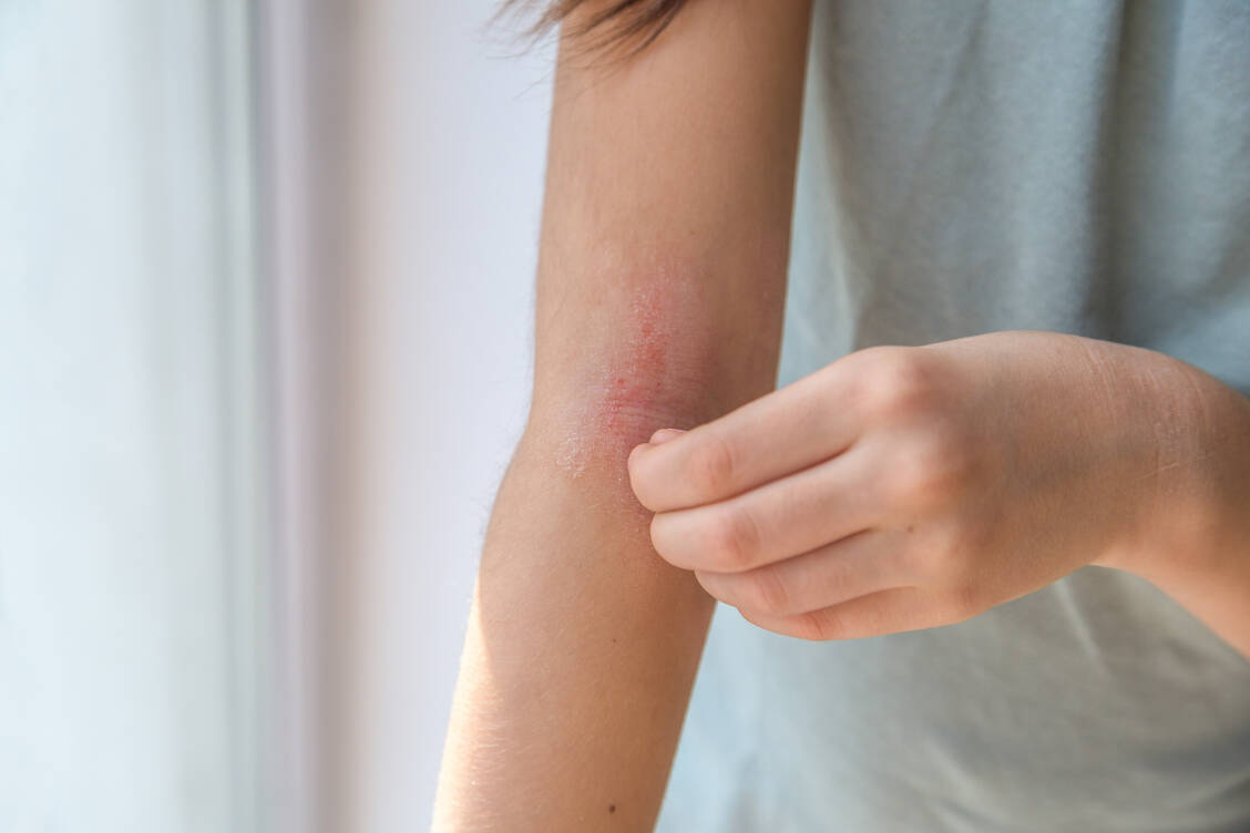 Atopische-Dermatitis-Rocatinlimab-verfolgt-neuen-Therapieansatz