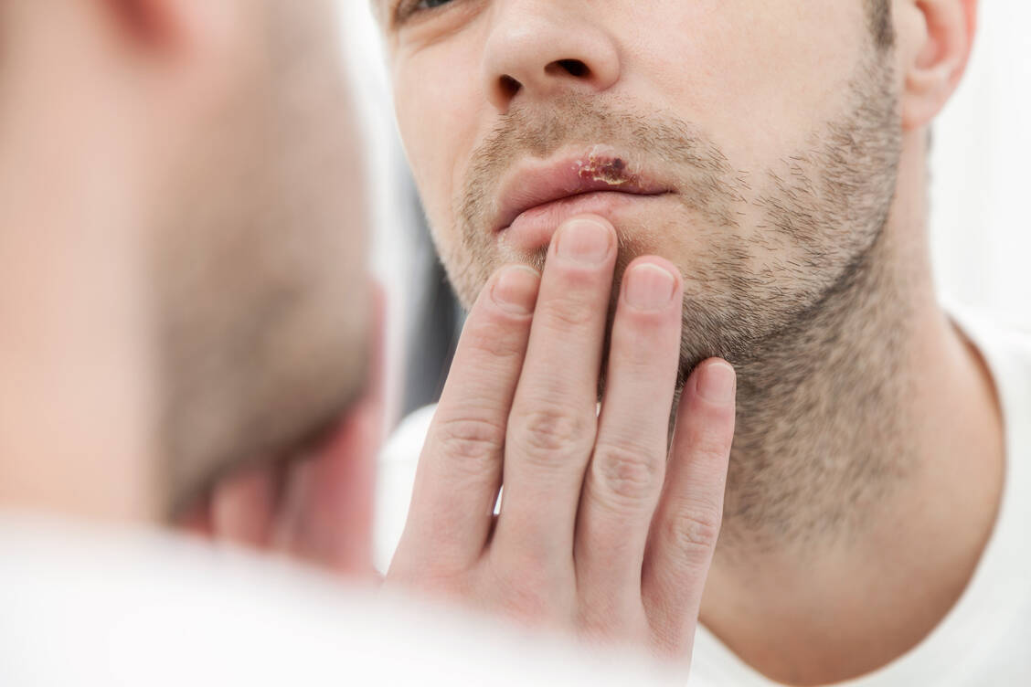 Herpes-Infektion-Pritelivir-Arzneistoff-mit-neuem-Wirkprinzip