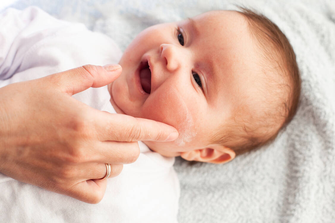 Besonders häufig tritt die atopische Dermatitis bei Säuglingen auf. Sie lässt oft in den ersten Lebensjahren nach und kann sogar ausheilen. / Foto: Getty Images/Vasyl Rohan
