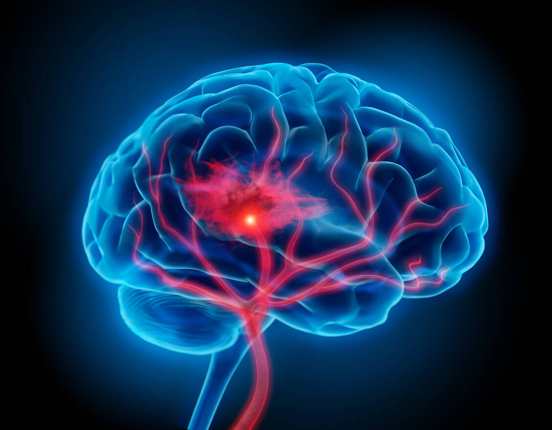 Bei einer 32-Jährigen kam es nach Vaxzevria-Impfung zu einer Immunreaktion und in der Folge zu einer Gerinnungsstörung mit Hirneinblutung, an der die Betroffene verstarb. / Foto: Adobe Stock/peterschreiber.media