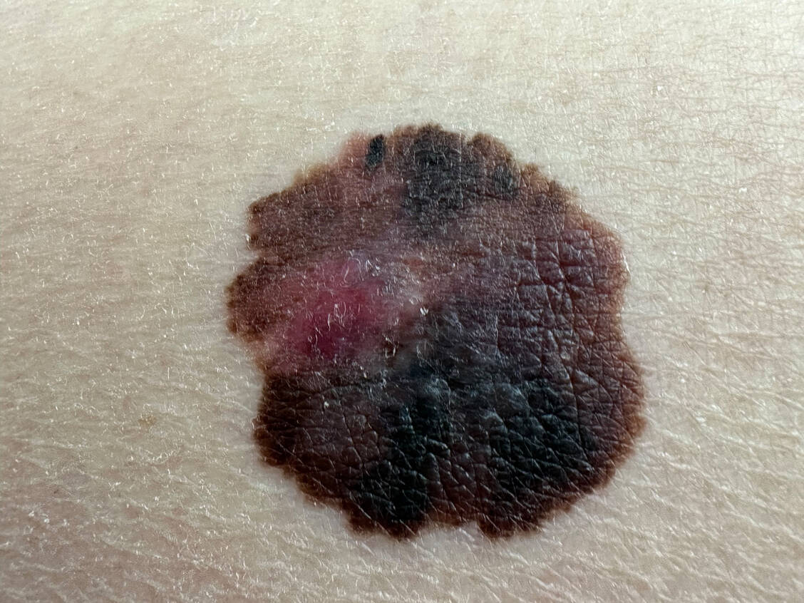 Die Kombination aus Nivolumab und Relatlimab ist nun zur Behandlung von Patienten mit malignem Melanom zugelassen. Möglicherweise wird das jedoch nicht die einzige Indikation bleiben. / © Getty Images/PS3000