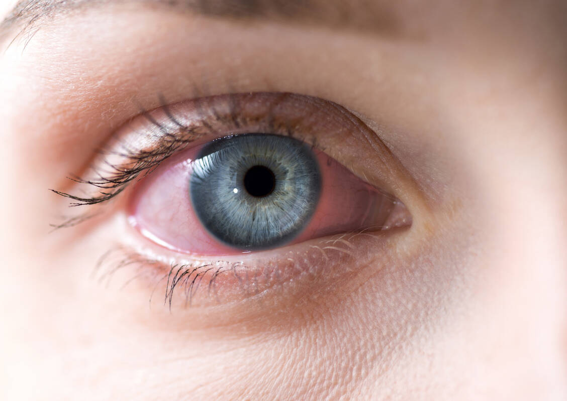 Viele Patienten mit dem Sjögren-Syndrom leiden an trockenen Augen, oft verbunden mit Bindehautentzündung. Auch andere Schleimhäute sind von starker Trockenheit betroffen.  / Foto: Adobe Stock/eevl