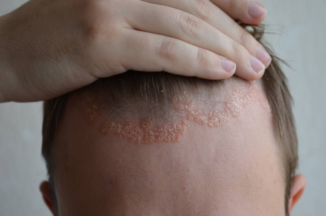 Zur Behandlung von Psoriasis auf der Kopfhaut wird häufig das sehr stark wirksame Glucocorticoid Clobetasolpropionat als Lösung mit 70-prozentigem Ethanol rezeptiert. / Foto: Stock Adobe/greshnikov1973