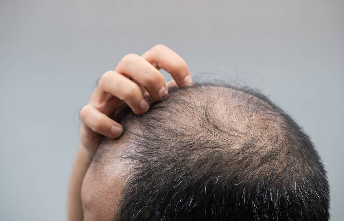 Leicht entzündliche Erkrankungen der Kopfhaut gehen zum Beispiel mit Juckreiz, Ekzembildung, Rötung oder Schuppung einher. / © GettyImages/ Boy_Anupong