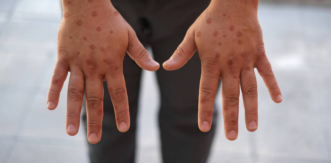 Mpox geht mit Fieber und Hautläsionen einher. Betroffene denken mitunter erst an Herpes, Rasierpickel oder Mückenstiche. Die Pusteln sind jedoch sehr schmerzhaft, juckend und zum Teil eitrig. / © Shutterstock/Selman Gedik