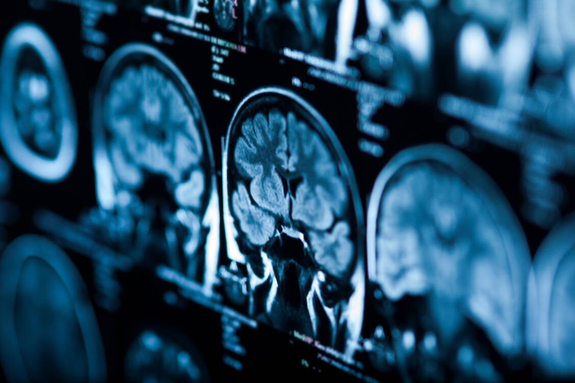 Für eine ursächliche Therapie der Parkinson-Erkrankung müsste man zugrunde gegangene dopaminerge Nervenzellen im Gehirn ersetzen. Erste klinische Studien mit Stammzelltransplantaten zeigen, dass dies sicher möglich ist. Ein Wirksamkeitsnachweis fehlt jedoch noch. / © Adobe Stock/merydolla