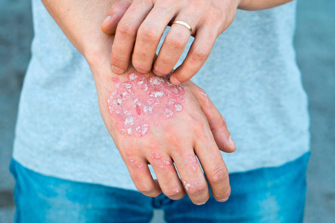 Typisch für Psoriasis sind scharf abgegrenzte rote Flecken mit silbrigen Schuppen. / Foto: Fotolia/Ban Orsolic