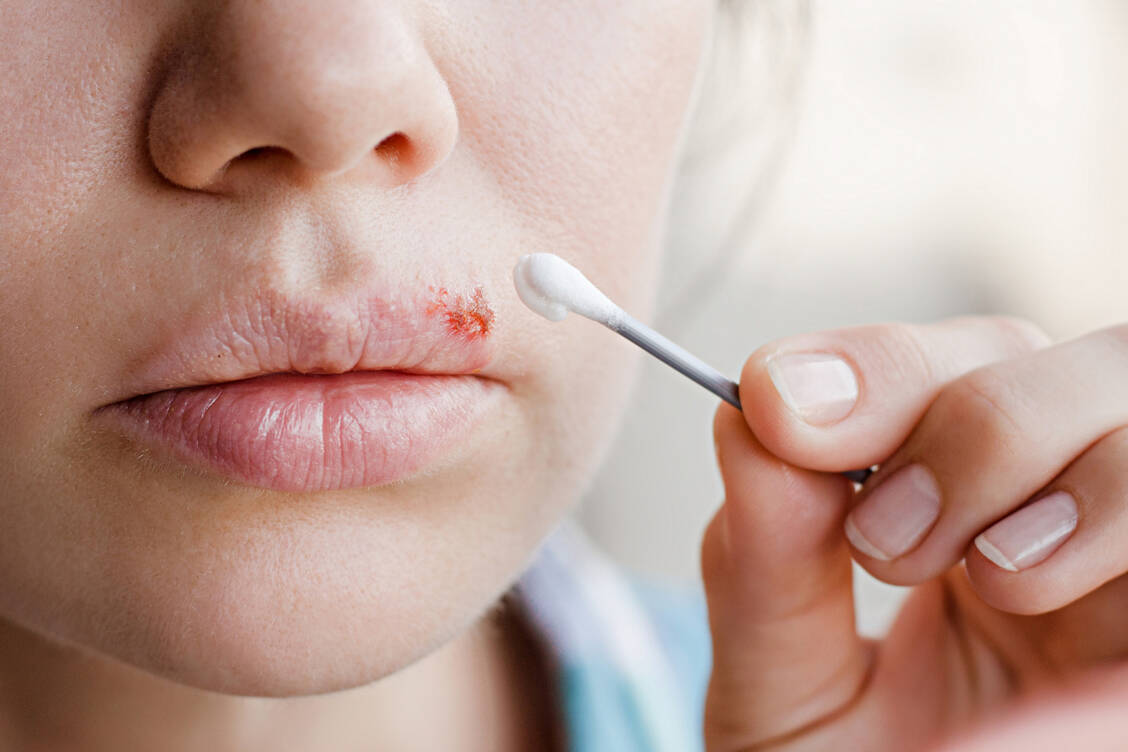 Lippenherpes wird in den meisten Fällen durch das Herpes-simplex-Virus 1 (HSV-1) ausgelöst. Mittel der Wahl in der Selbstmedikation sind Virostatika wie Aciclovir. / © Shutterstock/Domaskina