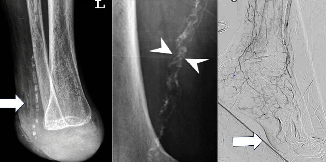 Abbildung 2: Gefäßverkalkungen bei Diabetes mellitus (von links): Mediasklerose, kalzifizierte Plaques und »Desert-Foot« bei Small Artery Disease / © Klein-Weigel