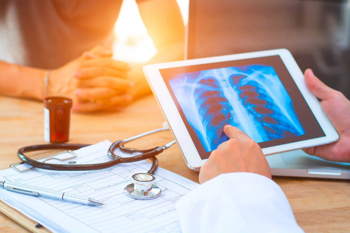 Trotz vieler Medikamente gibt es immer noch einen medizinischen Bedarf für neue Lungenkrebsmedikamente. Amivantamab könnte eines der nächsten werden. / Foto: Adobe Stock/seksan94