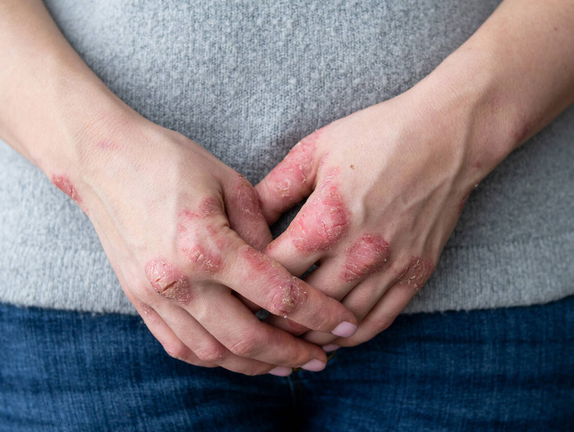 Die Psoriasis ist eine immunvermittelte entzündliche Erkrankung, die neben der Haut auch andere Organe betreffen kann. / Foto: Adobe Stock/IIIRusya