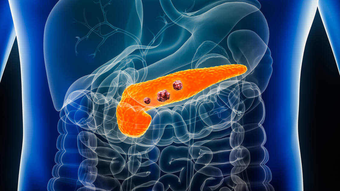 Das orale Mikrobiom kann das Risiko für Bauchspeicheldrüsenkrebs beeinflussen. / © Adobe Stock/Matthieu