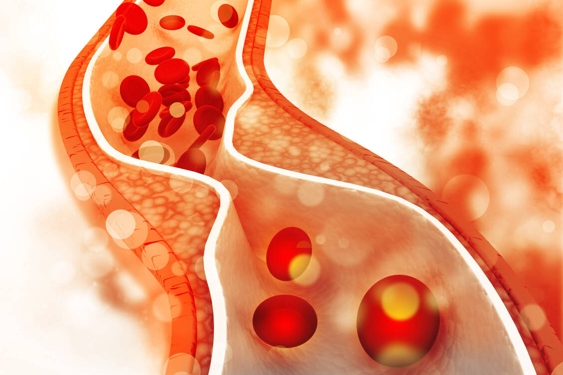 ASS, ein Statin und niedrig dosiertes Colchicin: Das wird vielleicht die wirksamste Kombination gegen Arteriosklerose sein. / Foto: Adobe Stock/hywards
