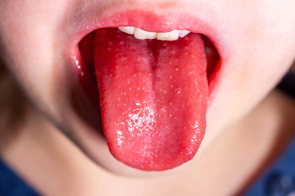 Die sogenannte Himbeerzunge, eine intensiv rot gefärbte Zunge mit Stippen, ist ein typisches Zeichen für Scharlach, das aber auch fehlen kann. / Foto: Adobe Stock/Lukassek