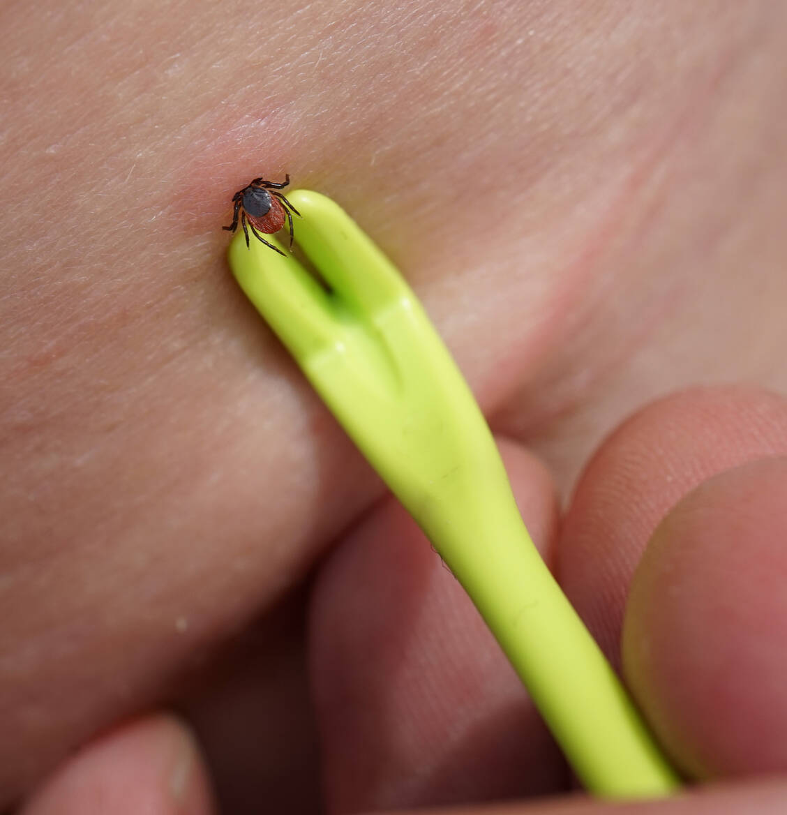 Zecken übertragen Borrelien nicht direkt beim Stich, sondern erst nach einigen Stunden. Deshalb sollten sie schnellstmöglich entfernt werden. / Foto: Adobe Stock/Sahara Frost