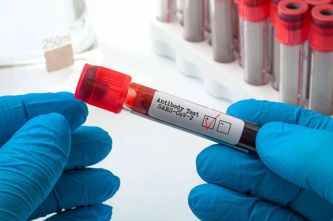 Der Test auf Antikörper ist der klassische Nachweis von einer Immunität gegen einen bestimmten Erreger. Im Fall von SARS-CoV-2 sind die Testsysteme nicht sehr verlässlich. / Foto: Adobe Stock/ Victor Moussa
