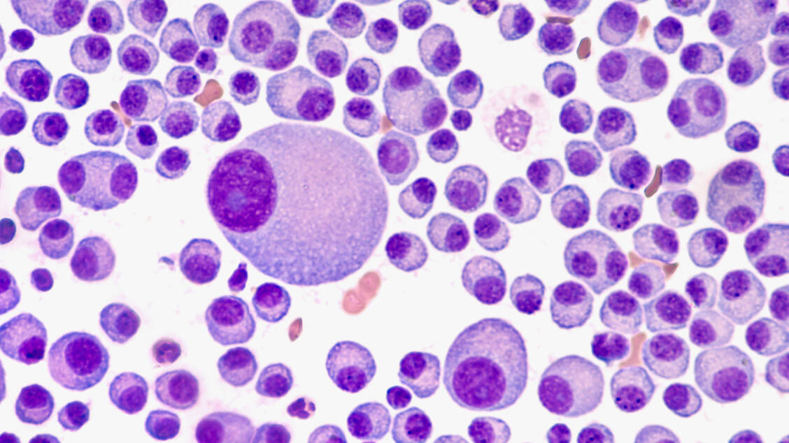 Die entarteten Plasmazellen zeigen sich im Knochenmarkausstrich von Patienten mit multiplem Myelom als große ovale Zellen mit breitem Zytoplasma und exzentrisch gelegenem Zellkern. / Foto: Adobe Stock/David A Litman