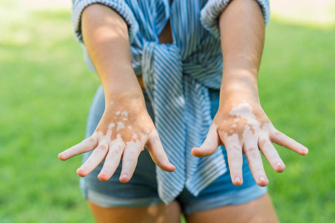 Die nicht segmentale Vitiligo ist die häufigste Form der Vitiligo. / © Getty Images/Westend61