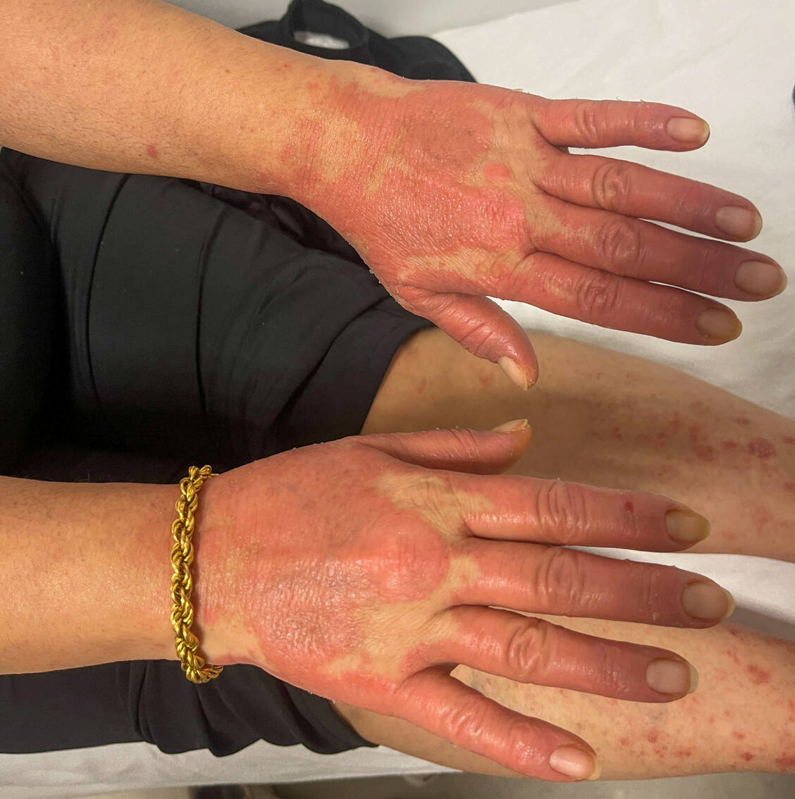 Lupus kann sehr vielfältige Symptome verursachen. Häufig zeigt sich die Autoimmunerkrankung an der Haut. / © Getty Images/Izzet Esmece