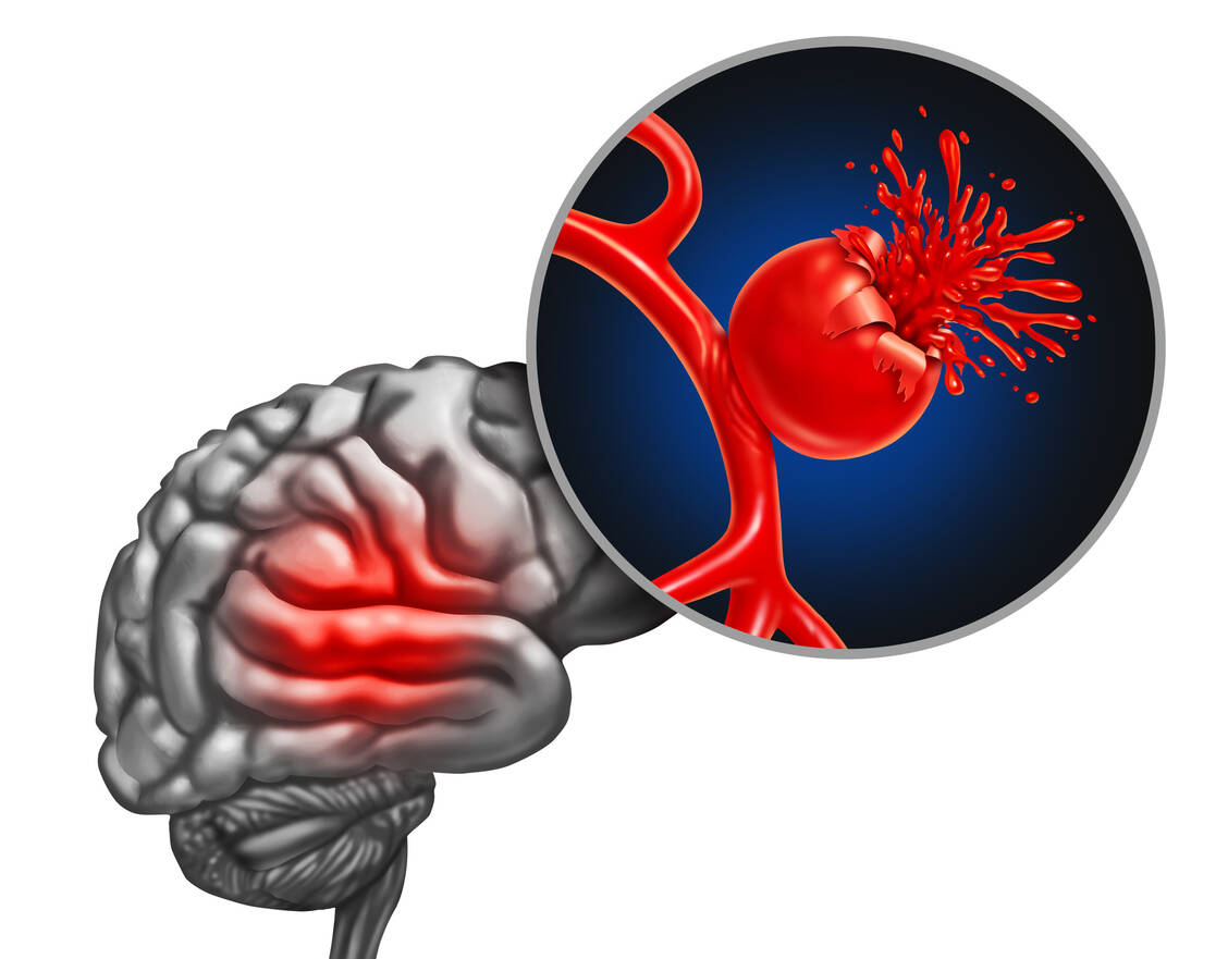 Ein Aneurysma im Kopf kann das Risiko für eine lebensgefährliche Hirnblutung deutlich erhöhen. / Foto: Adobe Stock/ freshidea