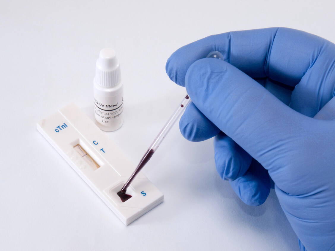 Manche Labortests machen sich die Bindung von Biotin und einem bestimmten Protein zunutze, um die Menge bestimmter Moleküle zu bestimmen, zum Beispiel des Troponin-Werts bei Verdacht auf Herzinfarkt. / © Imago/Depositphotos