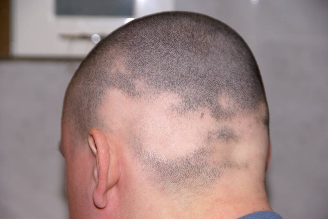  Mehr als eine Million Deutsche sind von Alopecia areata betroffen. / Foto: Adobe Stock/ Tomy