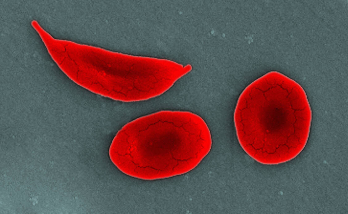 Bei der Sichelzellanämie verformen sich die Erythrozyten und verkleben. Zur Behandlung steht inzwischen auch das Gentherapeutikum Exagamglogen Autotemcel zur Verfügung. Nun ist erstmals ein Patient in Deutschland behandelt worden. / © Getty Images/Callista Images
