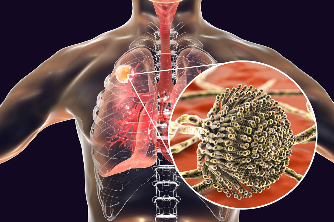 Eine Covid-19-assoziierte pulmonale Aspergillose, kurz CAPA, gehört zu den möglichen Komplikationen einer fortgeschrittenen Covid-19-Erkrankung. / Foto: Adobe Stock/Kateryna_Kon