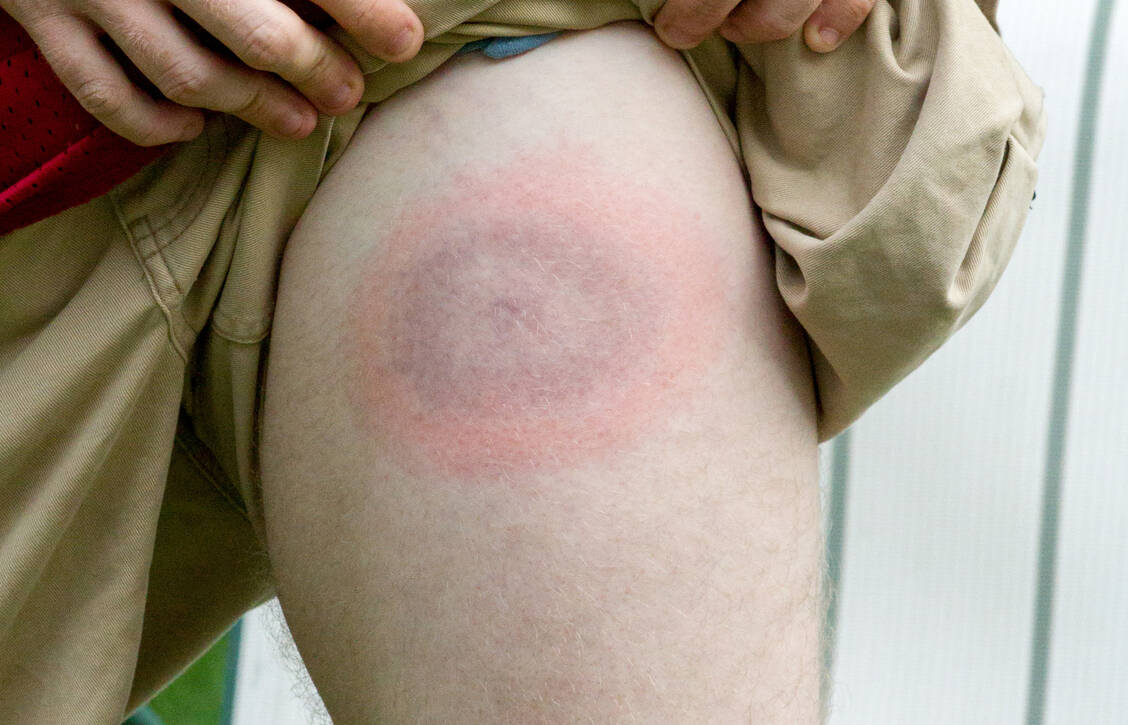 Kreisförmig um die Stelle des Zeckenstichs mit einem verblassenden Zentrum: Das ist die typische Wanderröte (Erythema migrans), die Frühmanifestation der kutanen Lyme-Borreliose. / Foto: Getty Images/JerryCallaghan