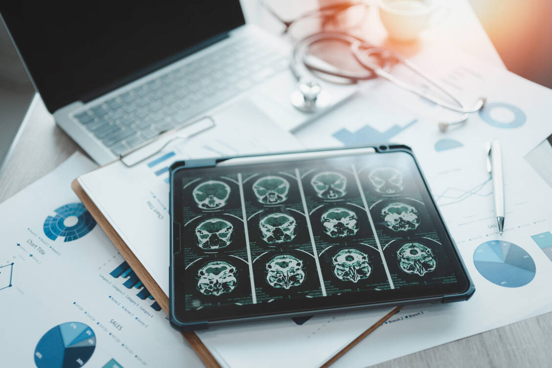 Donanemab soll das Fortschreiten der Alzheimer-Krankheit bremsen.  / © Getty Images/Teera Konakan
