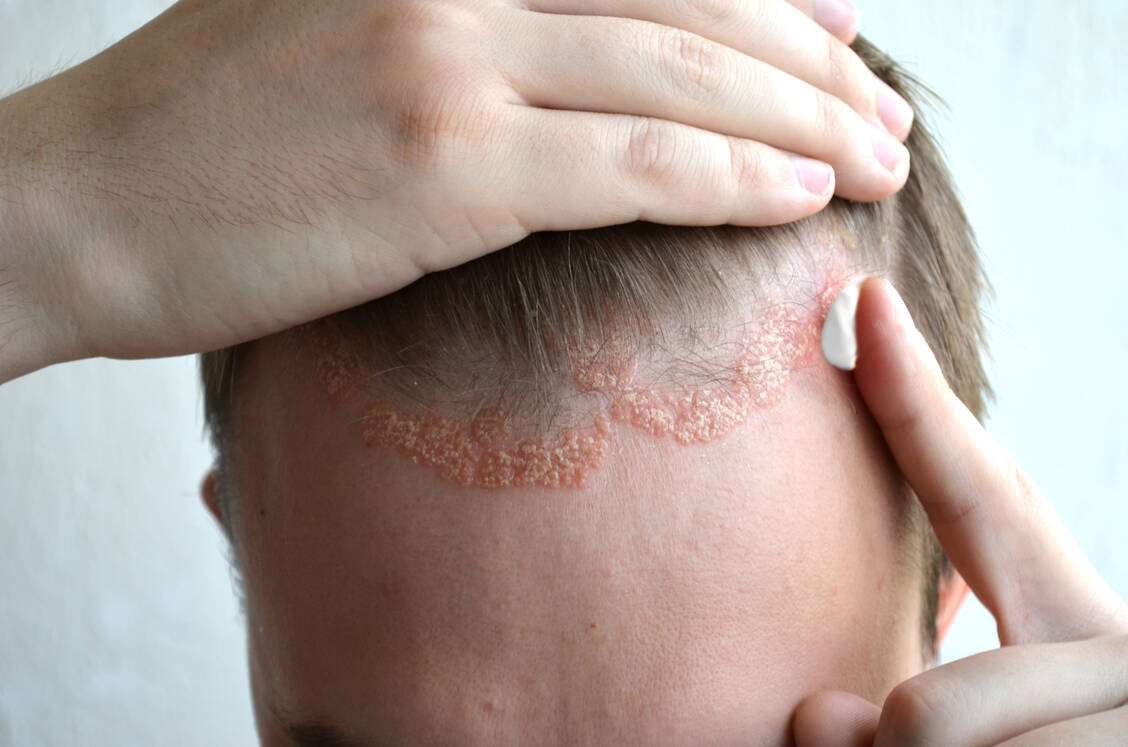 Eine Kopfhaut-Psoriasis ist stark stigmatisierend, da die Läsionen gut sichtbar über die Haargrenze hinausreichen. / Foto: Adobe Stock/VIlia
