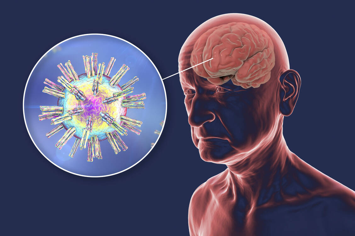 Forschende fanden einen assoziativen Zusammenhang zwischen Genital-Herpes und Demenz. Ob Herpesviren wirklich das Hirn schädigen, konnte noch nicht kausal nachgewiesen werden. / Foto: Getty Images/Science Photo Library/Kateryna Kon