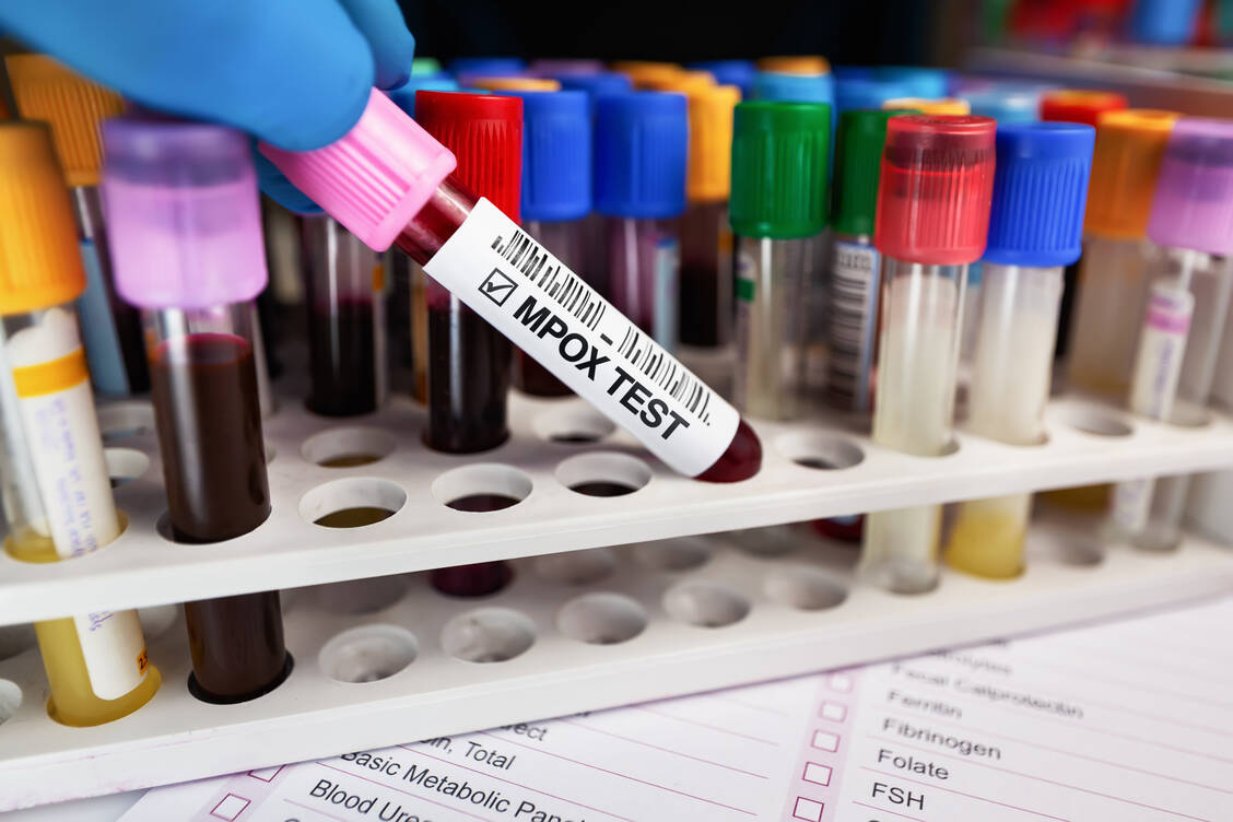 Weil Mpox-Viren bislang nur mit einem PCR-Test nachgewiesen werden können, der in vielen Ländern nicht zur Verfügung steht, bleiben dort viele Fälle unerkannt. / Foto: Getty Images/angellodeco