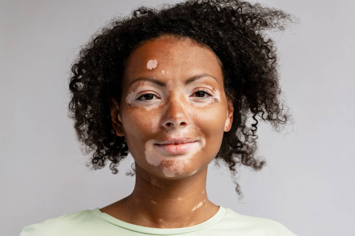 Zukünftig könnte womöglich eine Ruxolitinib-haltige Creme zur Behandlung von nicht segmentaler Vitiligo verfügbar sein.  / Foto: Adobe Stock/Drobot Dean