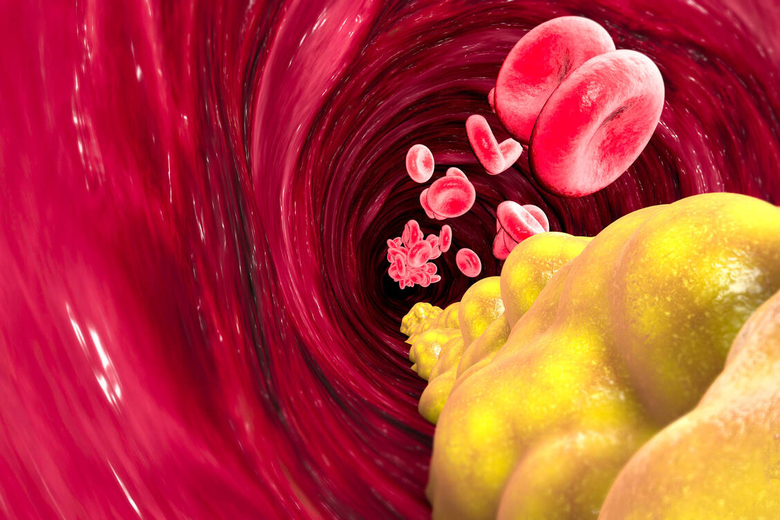 Ein erhöhter Lipoprotein(a)-Spiegel geht ebenso wie ein erhöhter LDL-Cholesterin-Spiegel mit einem erhöhten Risiko für Arterienverkalkung einher.  / Foto: Getty Images/Naeblys