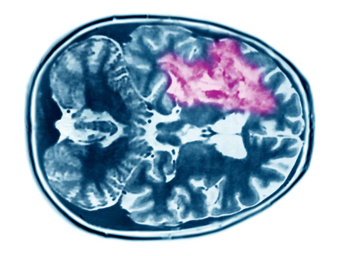Dieser Hirntumor hat große Teile der linken Hirnhälfte infiltriert. / Foto: Your Photo Today