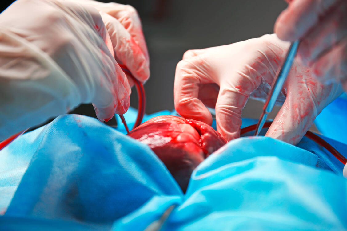 Bei Operationen am offenen Herzen muss eine Herz-Lungen-Maschine die Funktion des Organs übernehmen. / Foto: Shutterstock/Africa Studio