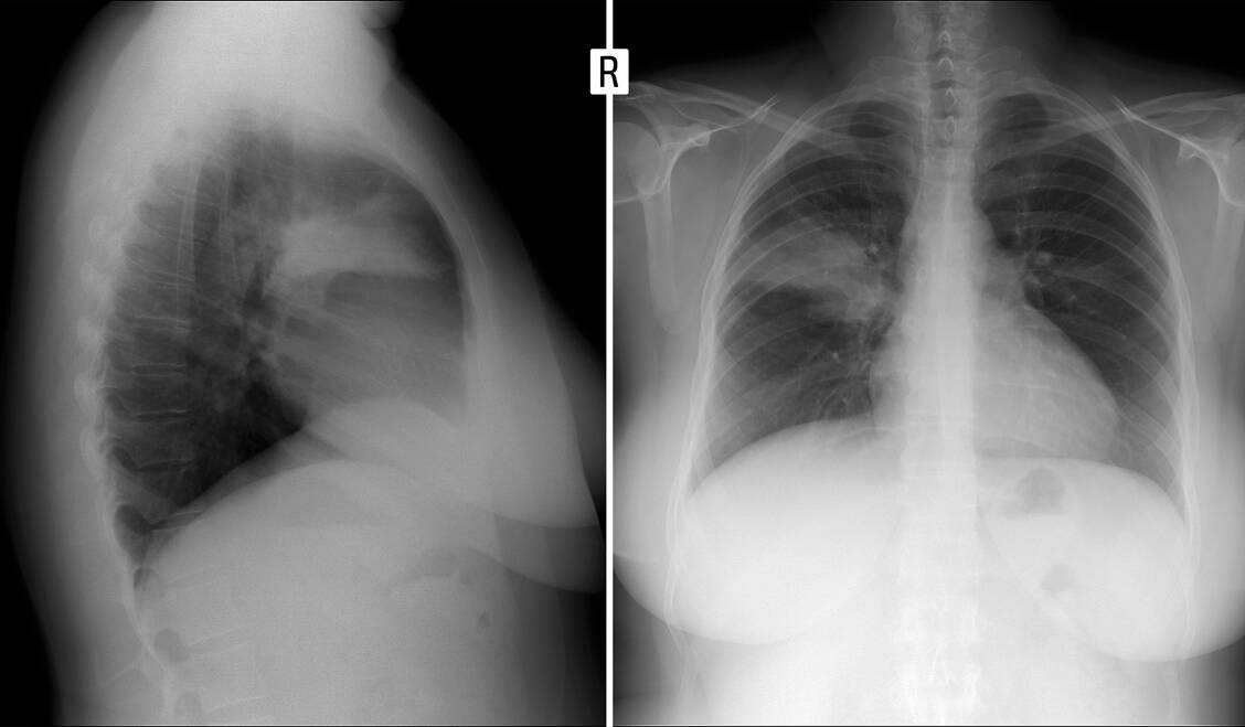 Röntgenaufnahme der Lunge (Ausschnitt in zwei Ebenen): Es ist eine Pneumonie im Lungenoberlappen rechts zu erkennen (Segment 2). / Foto: Shutterstock/Vanzittoo