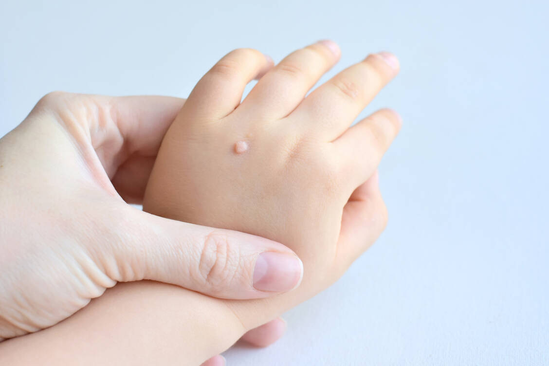 Warzen sind bei Kindern keine Seltenheit, da ihr Immunsystem noch nicht ausgereift ist. Eine Schälkur mit Salicylsäure ist schon für die ganz Kleinen geeignet; Vereisungssprays meistens ab vier Jahren. / Foto: Adobe Stock/Tanya Ivanova
