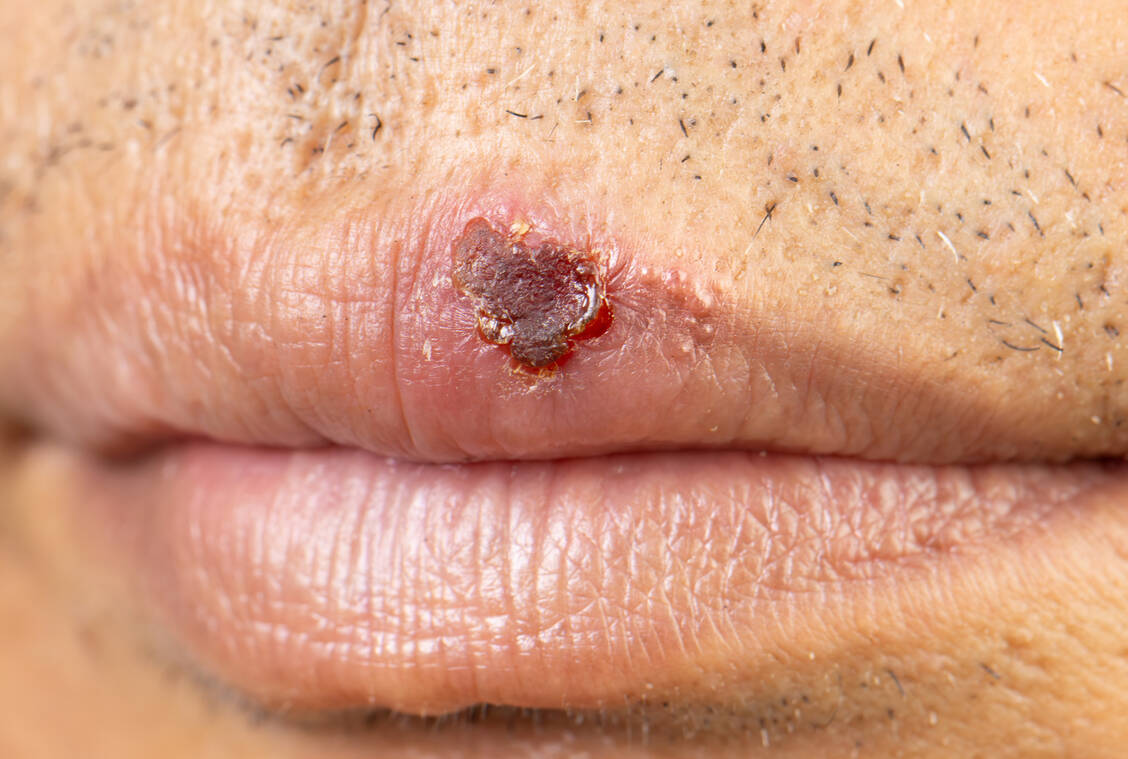 Herpes-simplex-Viren vom Typ 1 (HSV-1) verursachen meist Lippenherpes. Bei Menschen mit geschwächtem Immunsystem können HSV-Infektionen  schwer verlaufen und ernsthafte Komplikationen hervorrufen. / © Getty Images/Toa55