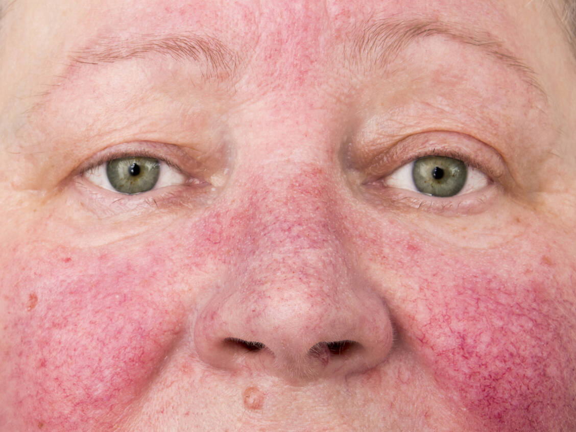 Frauen und Männer trifft die Rosacea fast gleichermaßen, doch erkranken Frauen zumeist früher. / Foto: Adobe Stock/Milan Lipowski