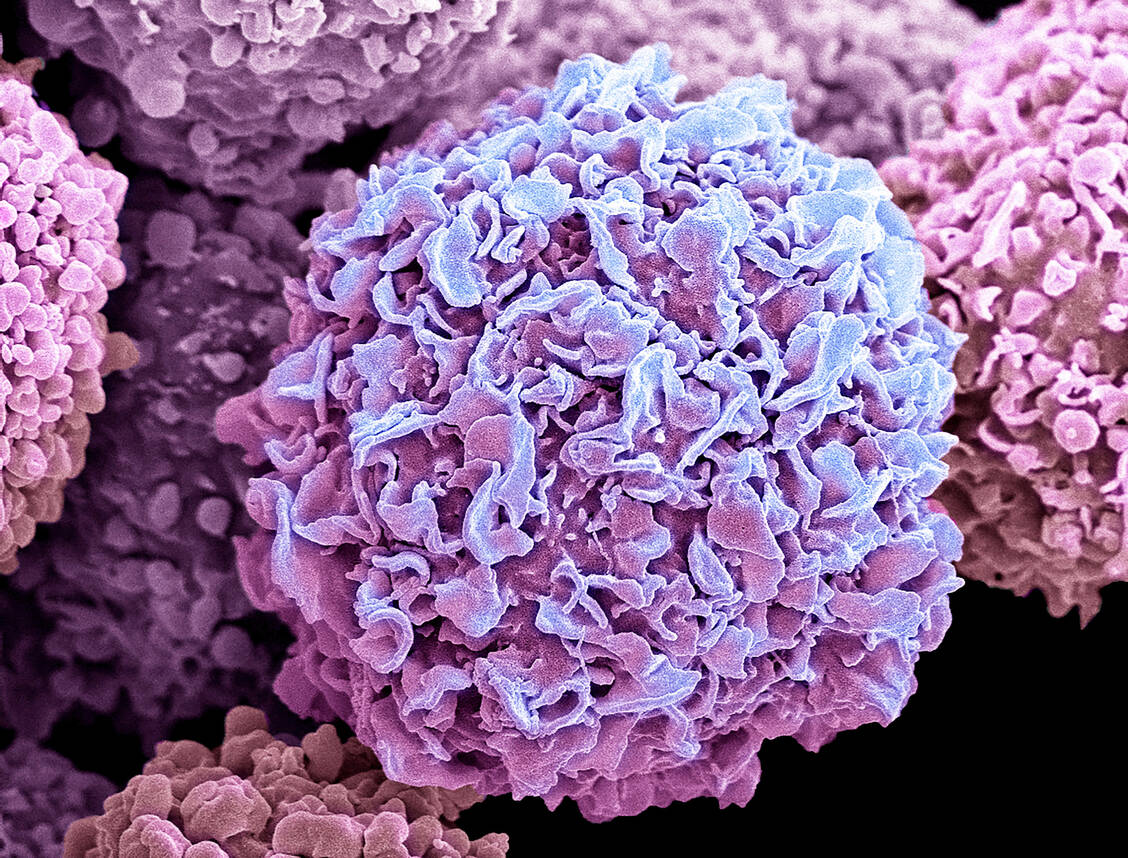 CTC sind Zellcluster, die sich aus einem Primärtumor abgesondert haben und im Blut nachweisbar sind. Sie sind mit einer erhöhten Metastasierungsneigung assoziiert. / © Getty Images/Steve Gschmeissner/Science Photo Library