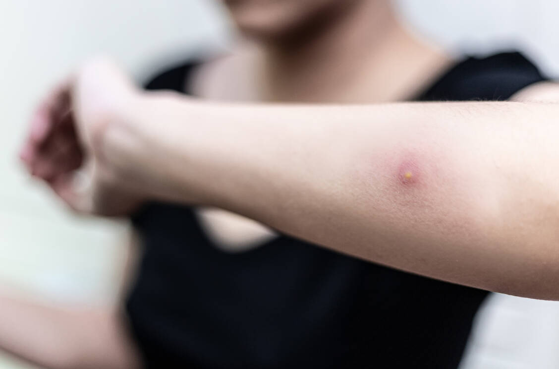 Ein Abszess ist eine Abwehrreaktion des Körpers auf eingedrungene Bakterien, meist Staphylokokken. / © Getty Images/catinsyrup