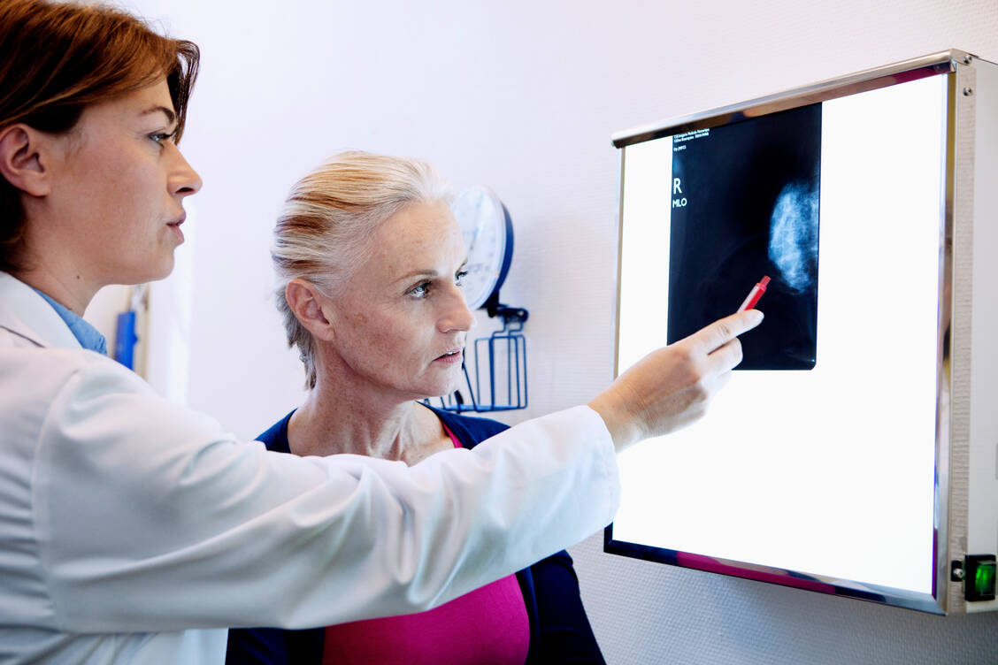Ärzte haben mit Elacestrant erstmals eine Behandlungsoption für weibliche und männliche Patienten mit Brustkrebs, deren Tumoren ESR1-Mutationen aufweisen. Diese Mutationen sind eine bekannte Ursache einer Resistenz gegen endokrine Standardtherapien. / Foto: Getty Images/BSIP/UIG