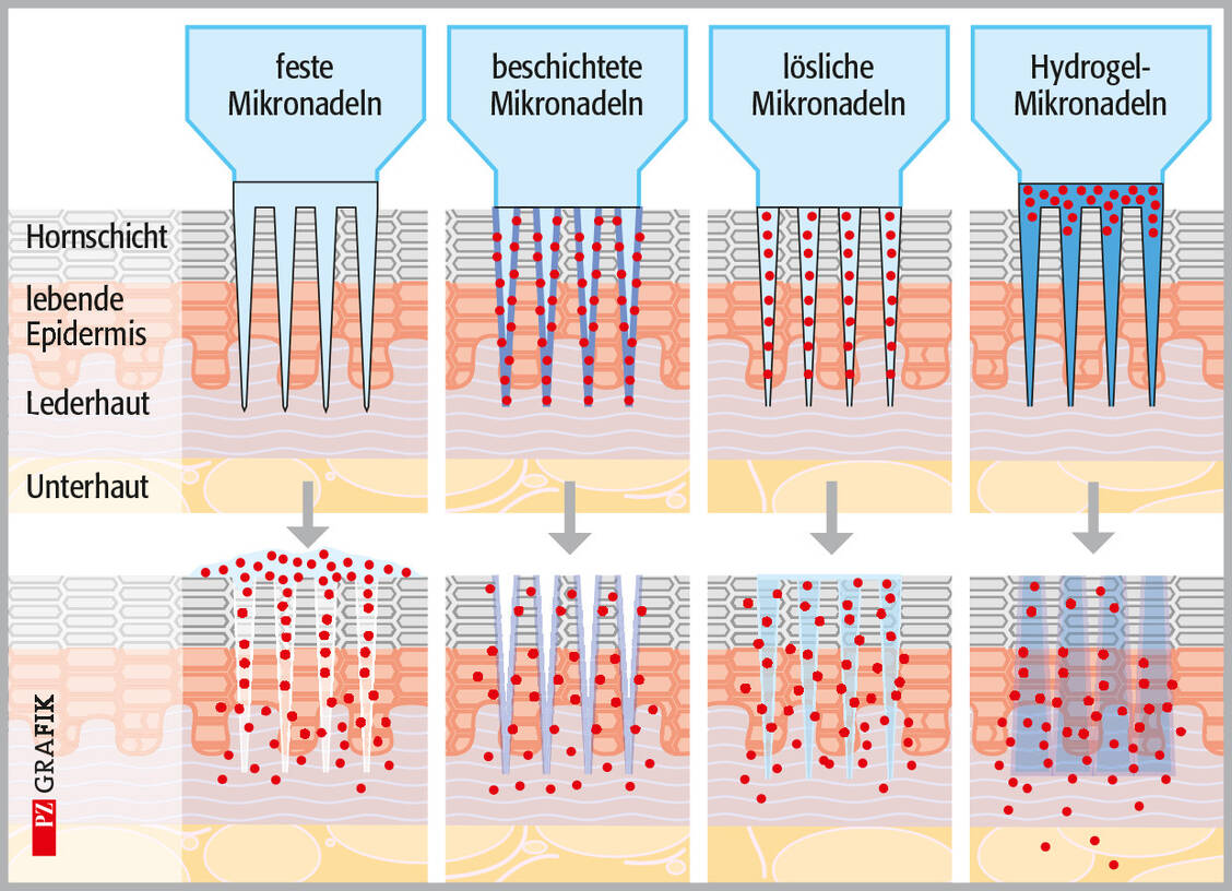 Abbildung 2: Arten von Mikronadelsystemen und Mechanismus des Wirkstofftransports in die Haut / © PZ/Stephan Spitzer